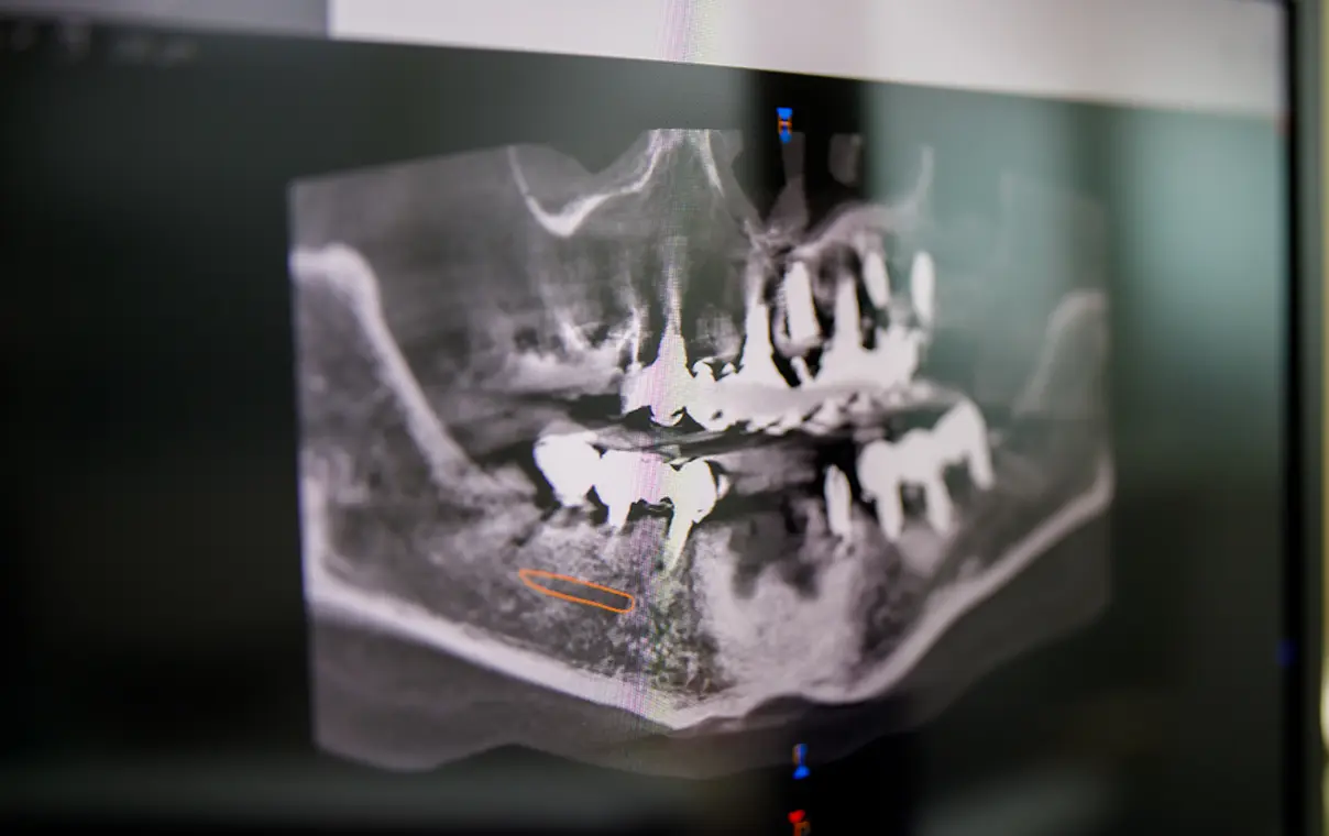 インプラント症例集