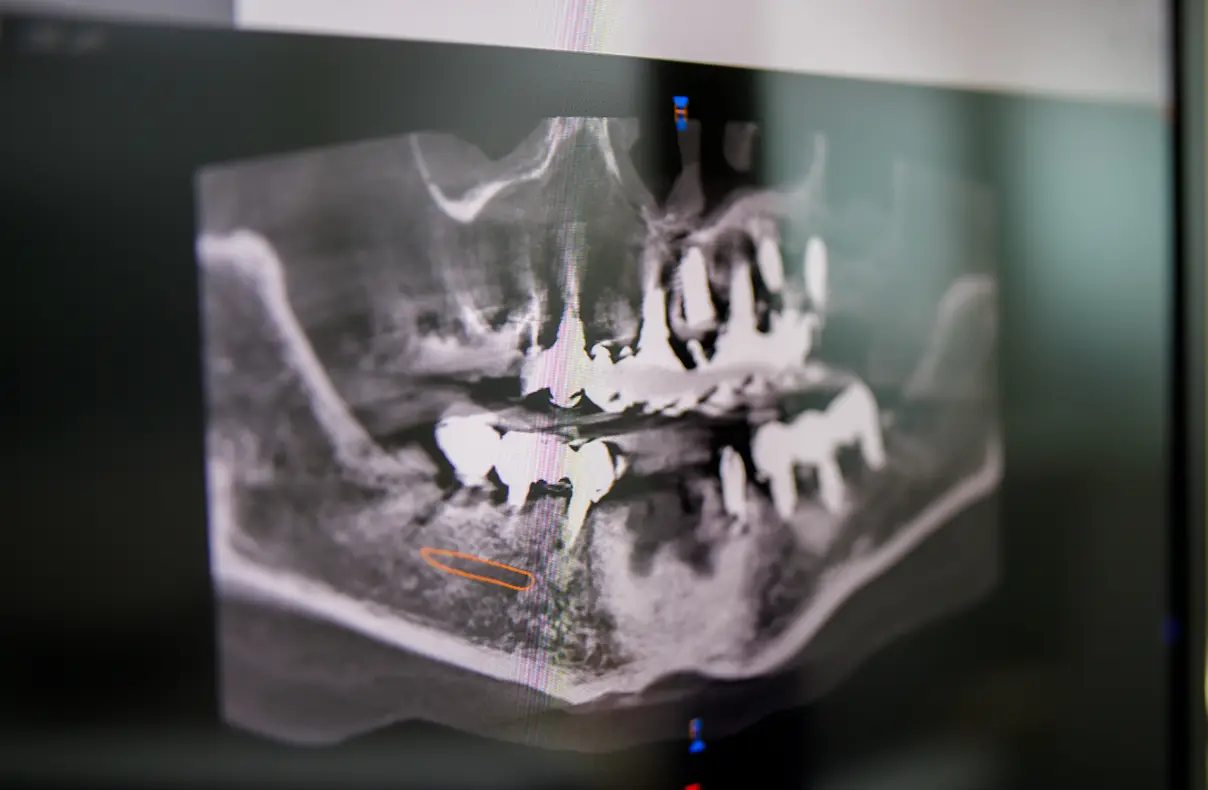 保険のパノラマレントゲン写真をプレゼント
